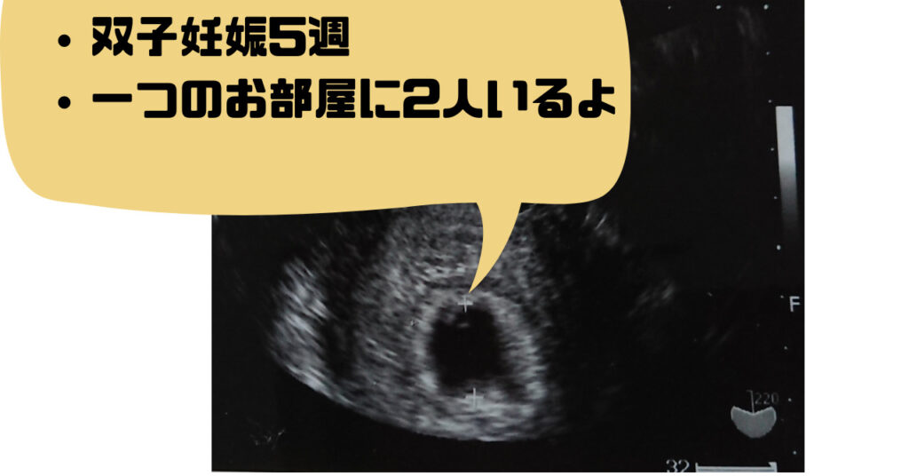【妊娠5週目】膜性診断により一卵性双生児の妊娠発覚